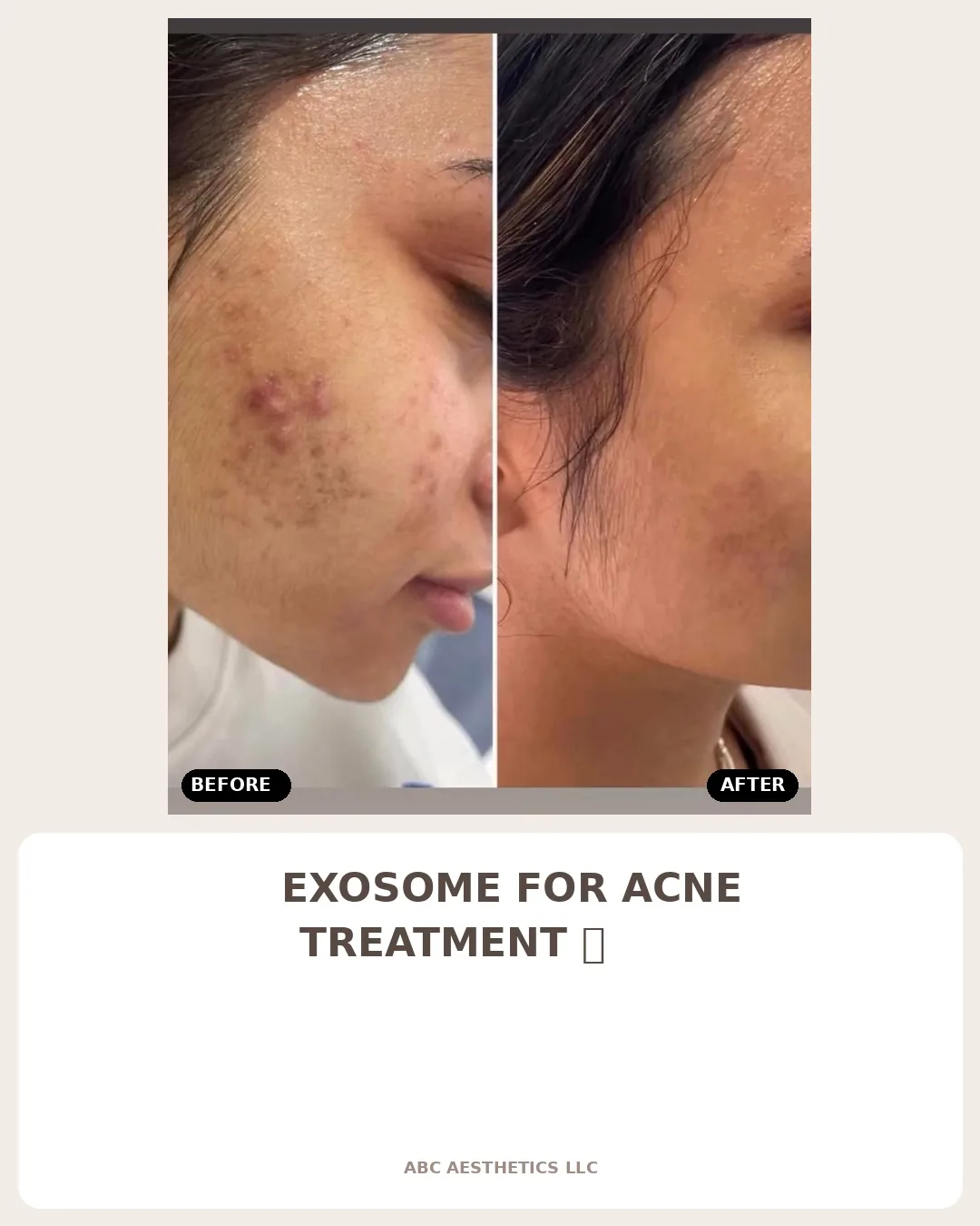 Acne &mdash; exosome treatment