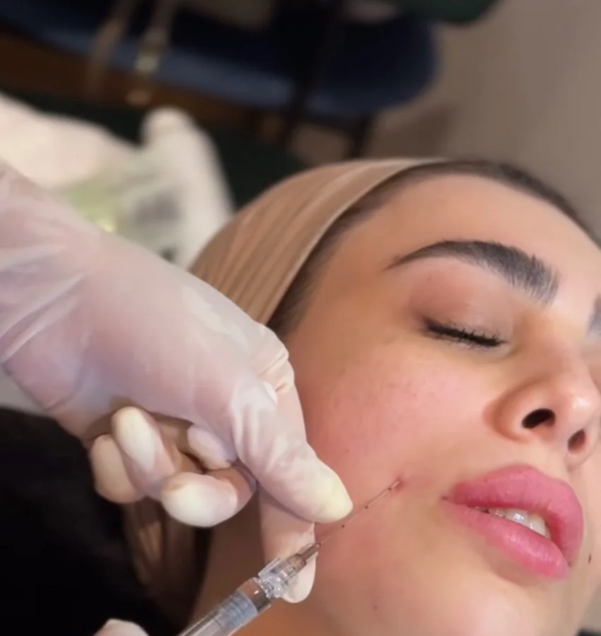 Dermal filler treatment