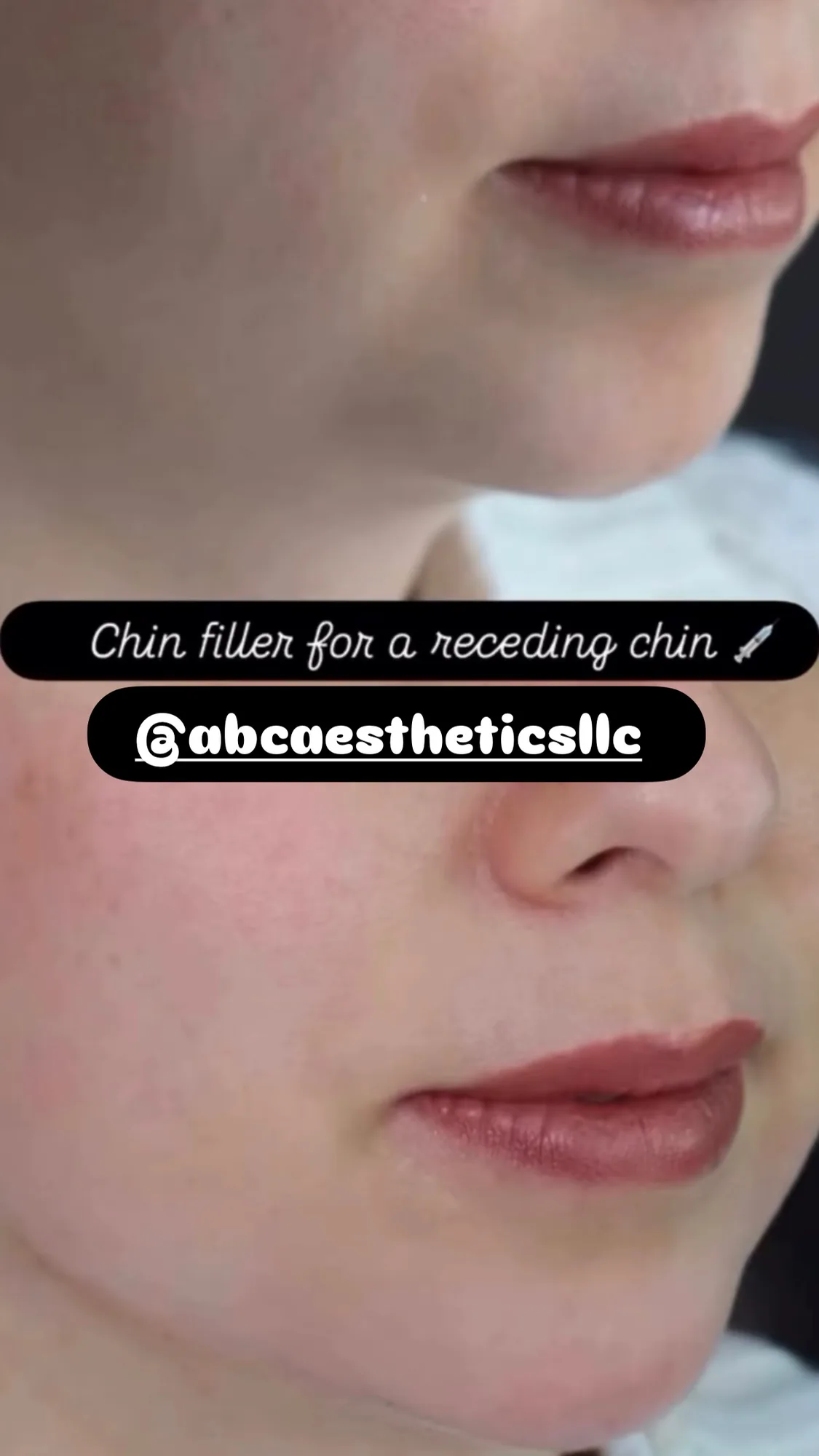 Chin filler &mdash; receding chin