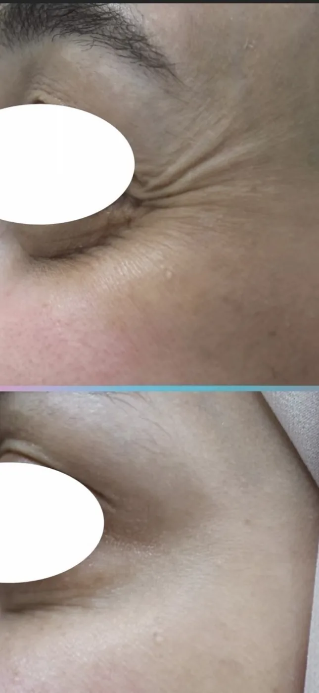 Crow's feet before and after