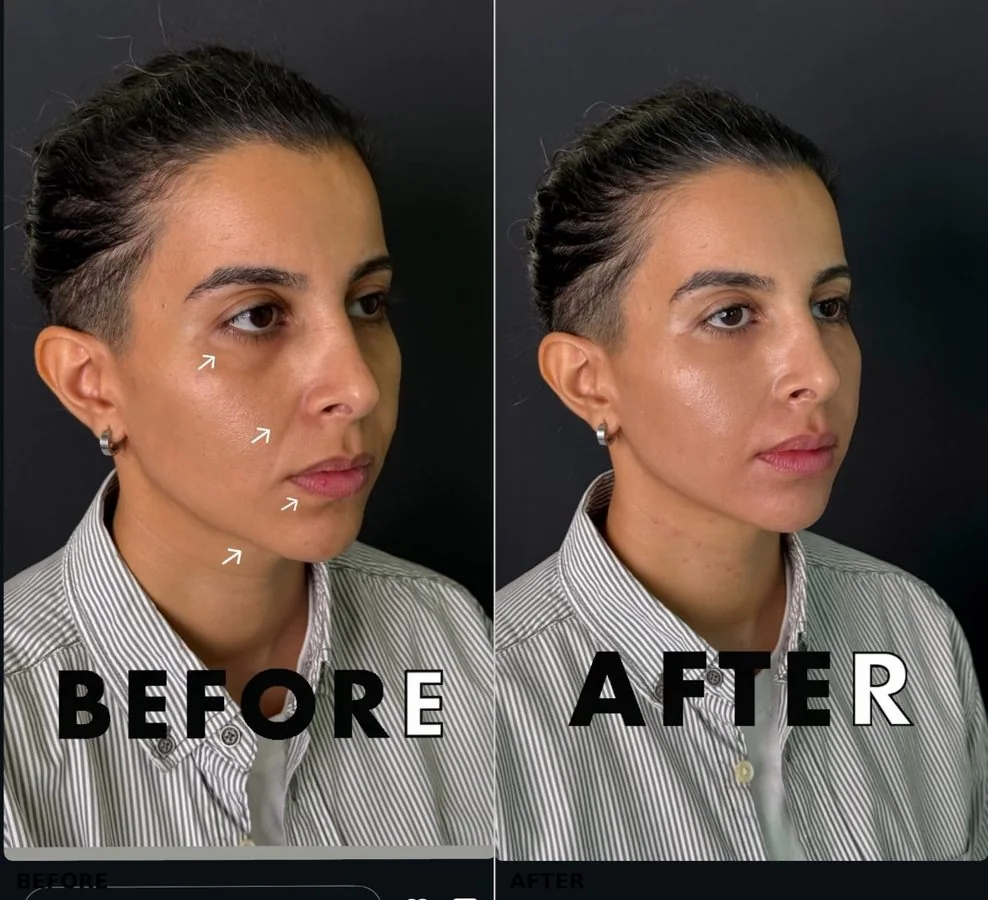 Dermal filler &mdash; midface & jawline