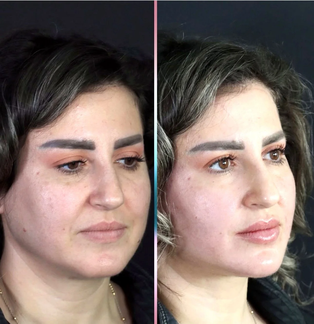 A patient before and after dermal filler for facial balancing