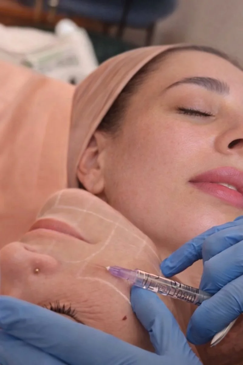 Dermal Fillers & Biostimulators