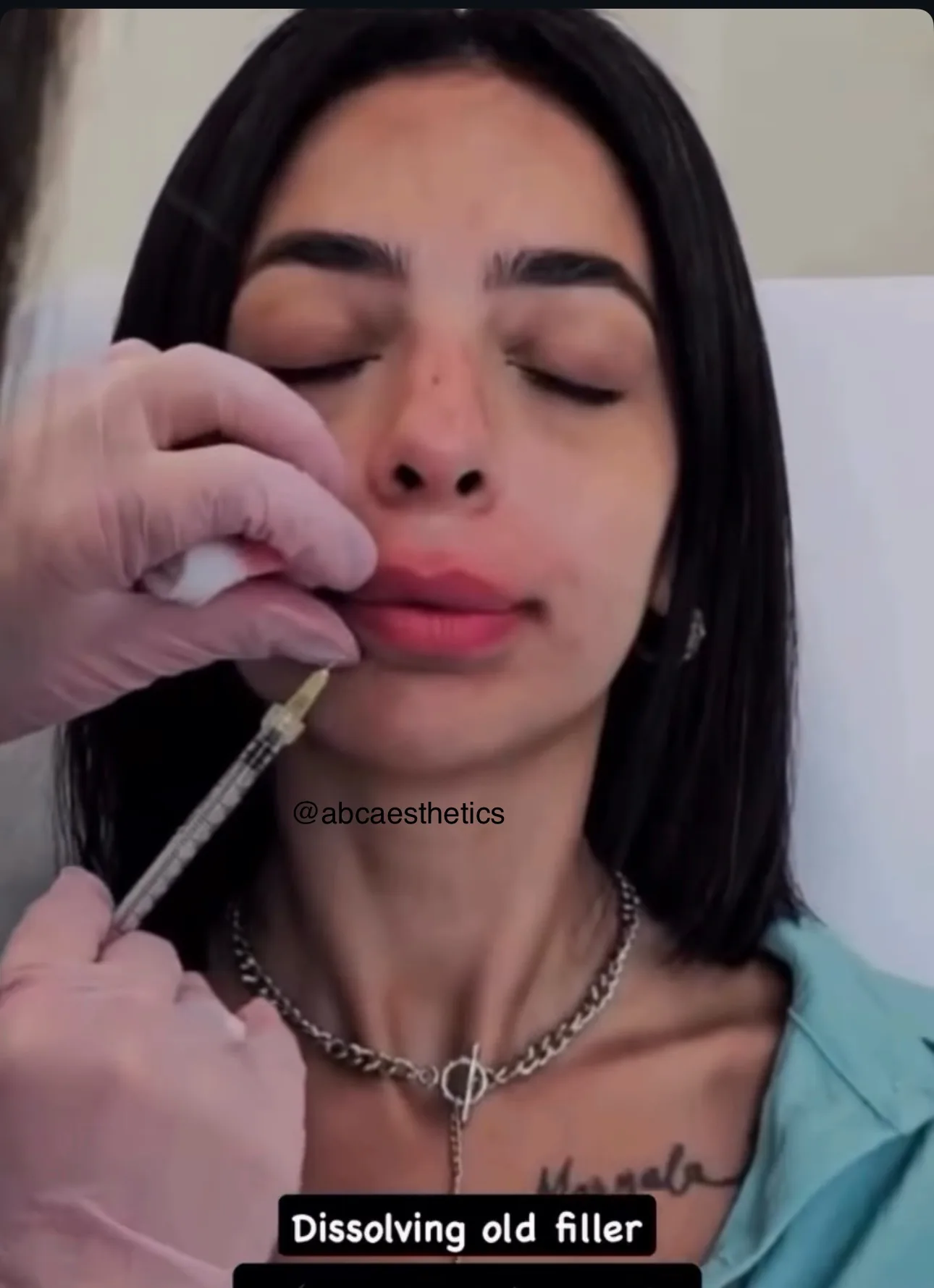 Sculptra&reg;