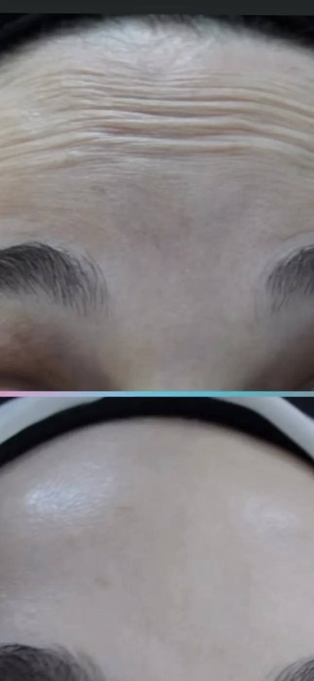 Forehead lines before and after