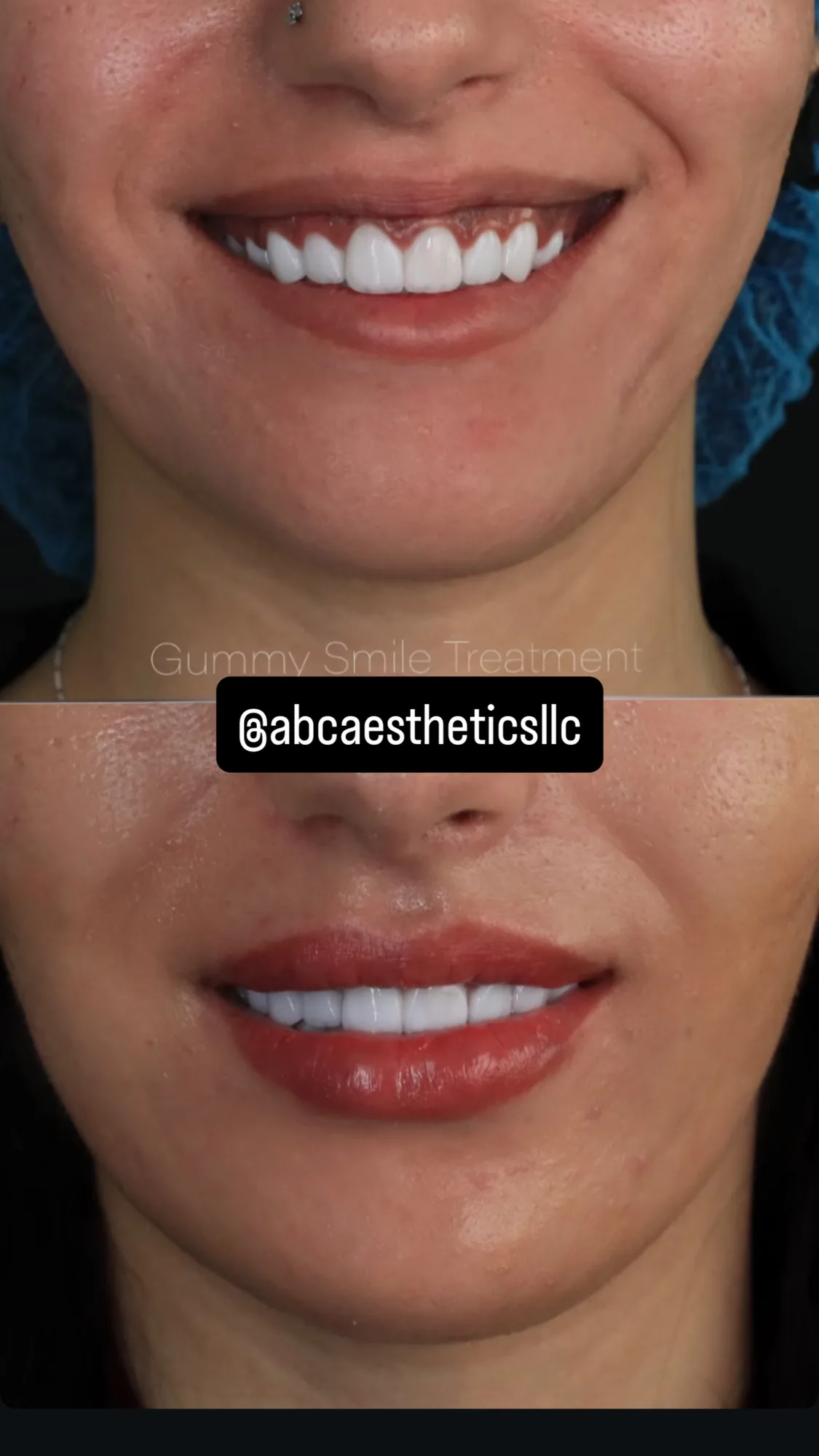 Gummy smile treatment