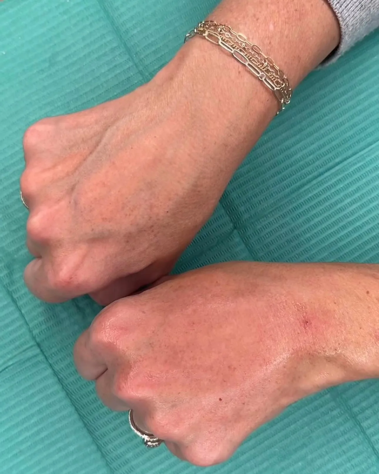 Hand treatment