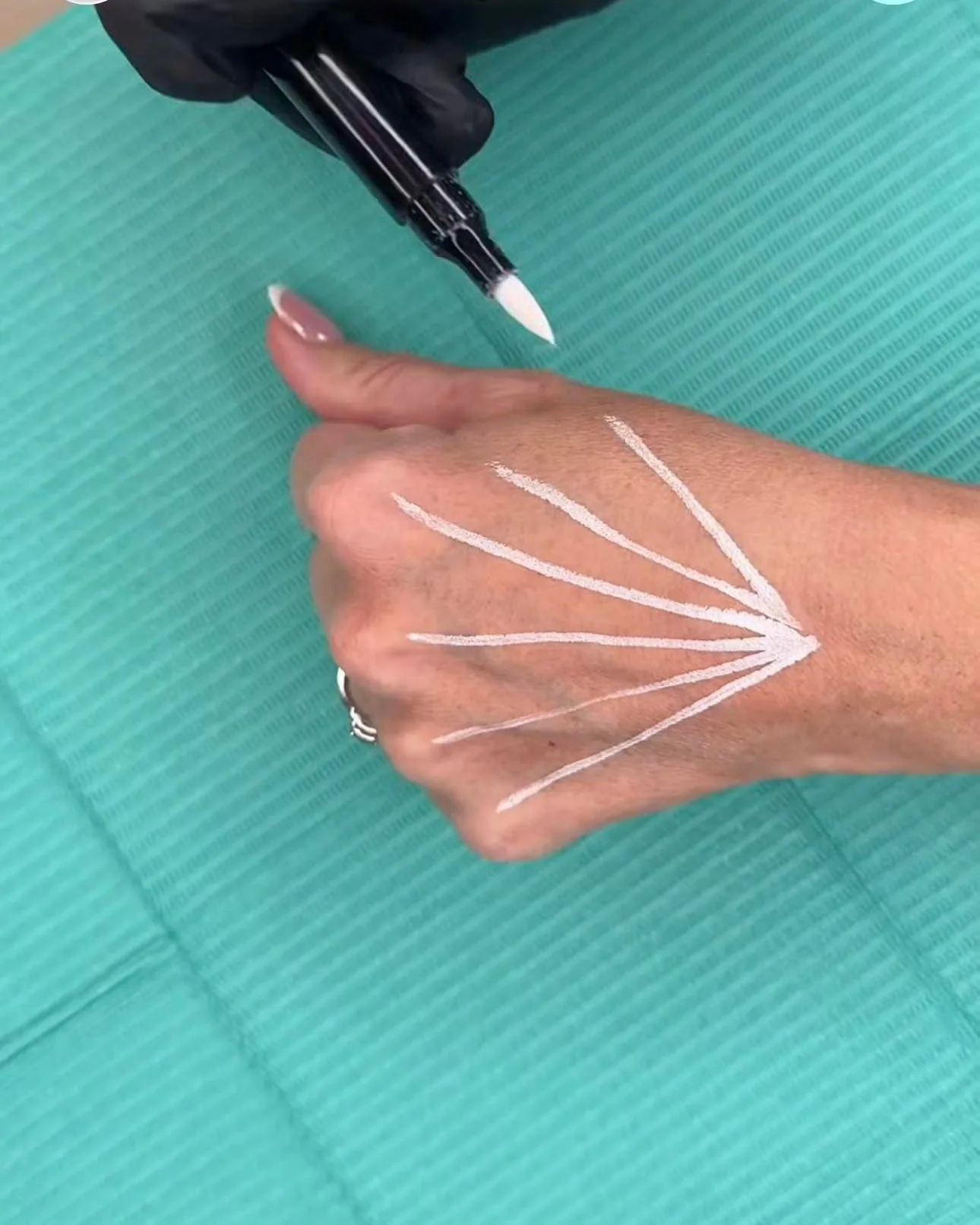 Hand rejuvenation &mdash; treatment mapping