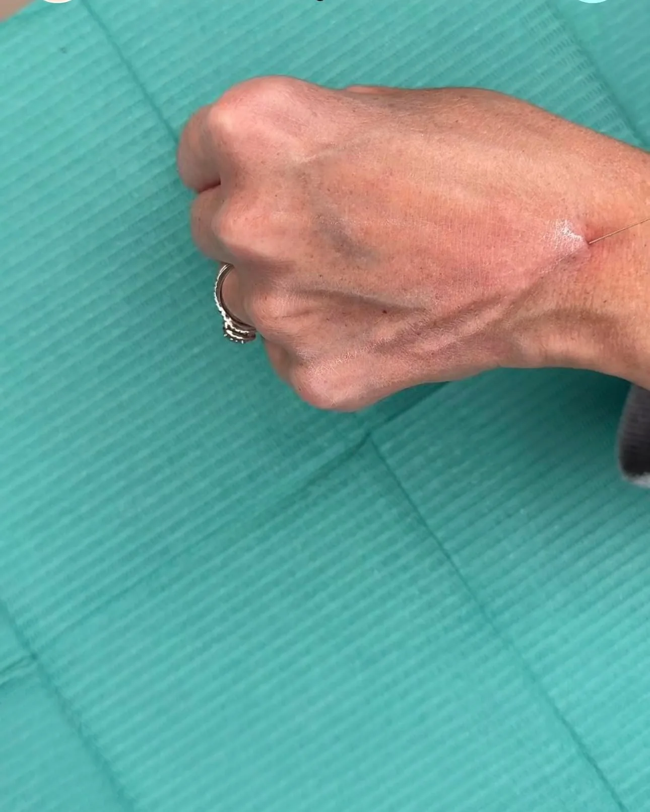 A patient&rsquo;s hand resting on a drape during treatment
