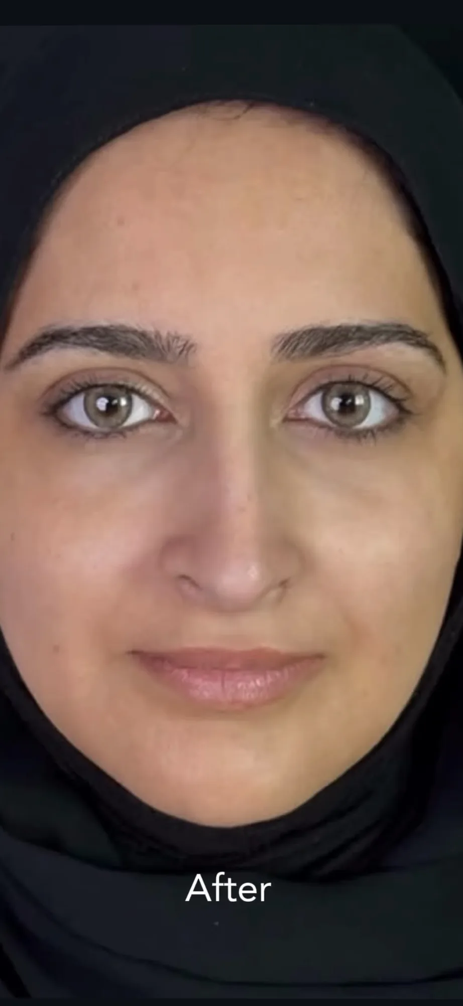 Facial balancing &mdash; after