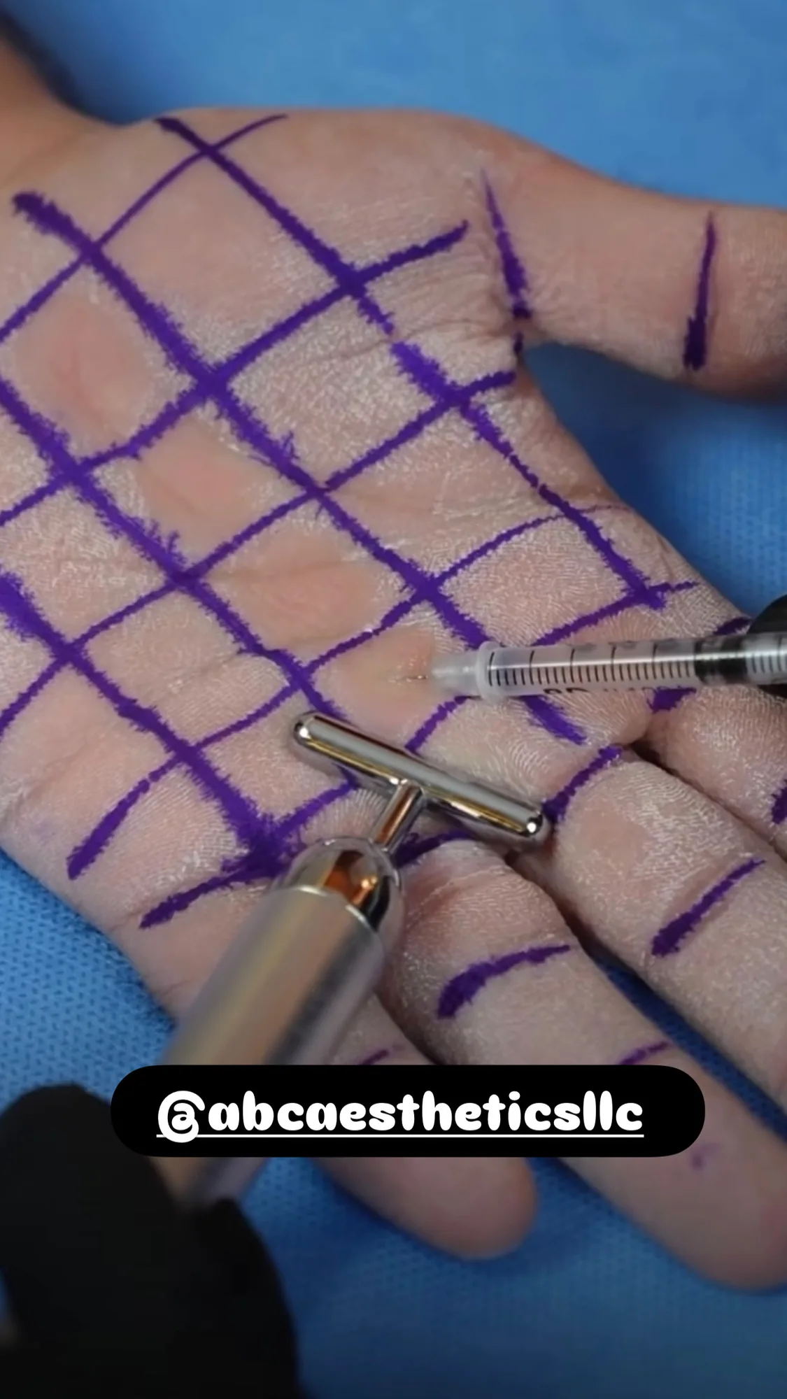 Hyperhidrosis treatment