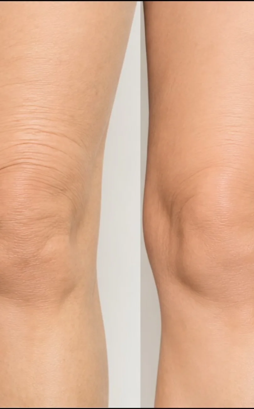 Skin laxity above the knee