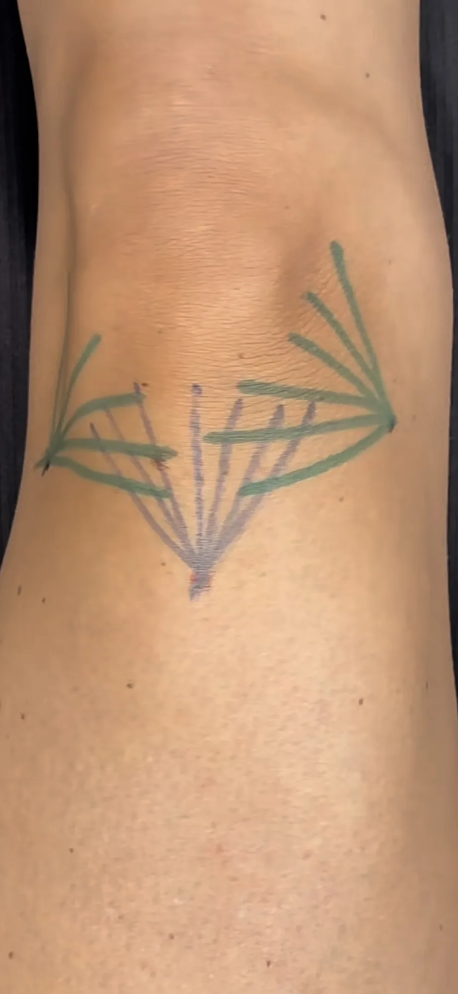 Injection technique