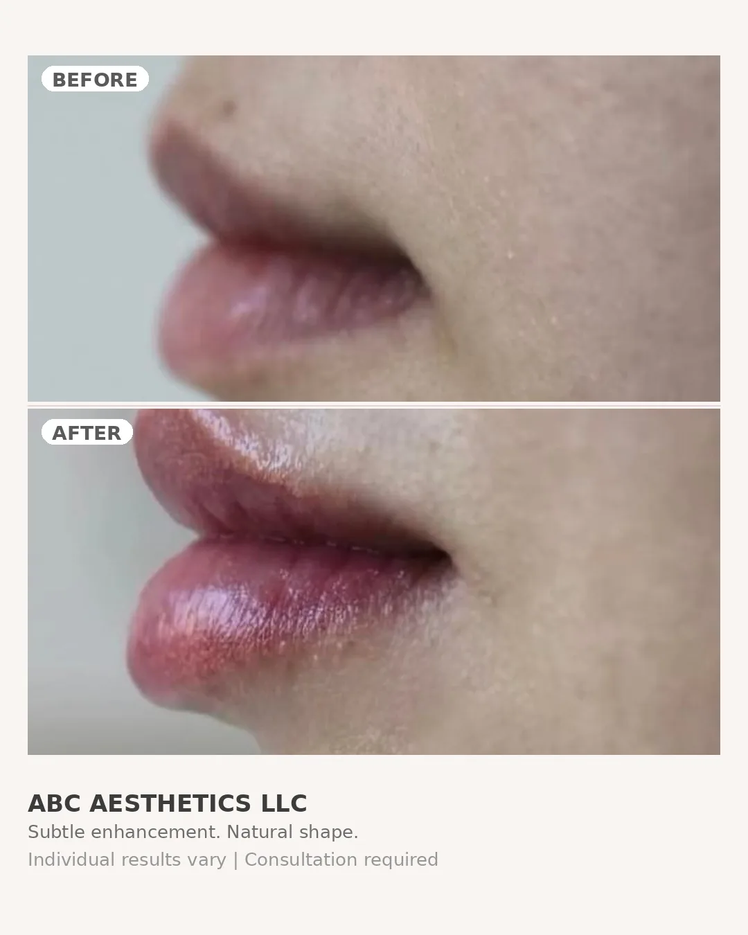 Lip treatment