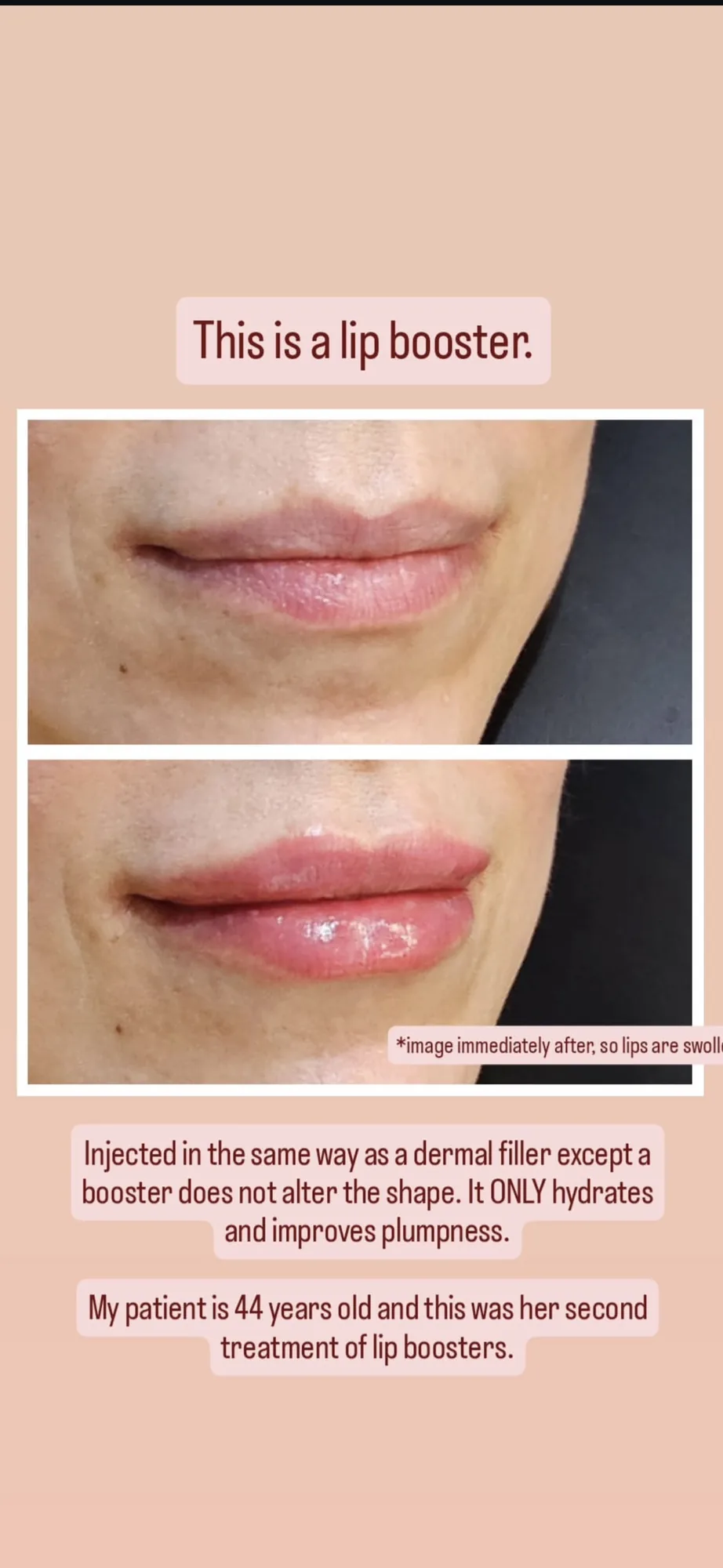 Lip boosters