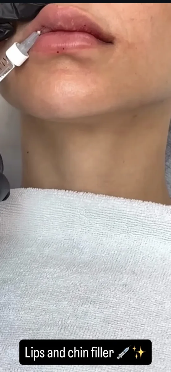 Lip and chin filler