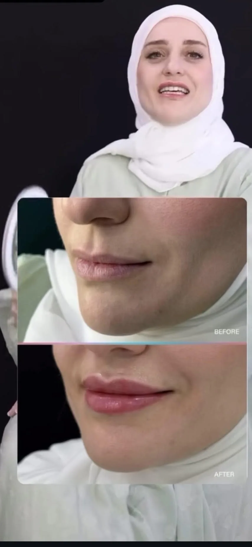 Lip filler &mdash; volume & definition