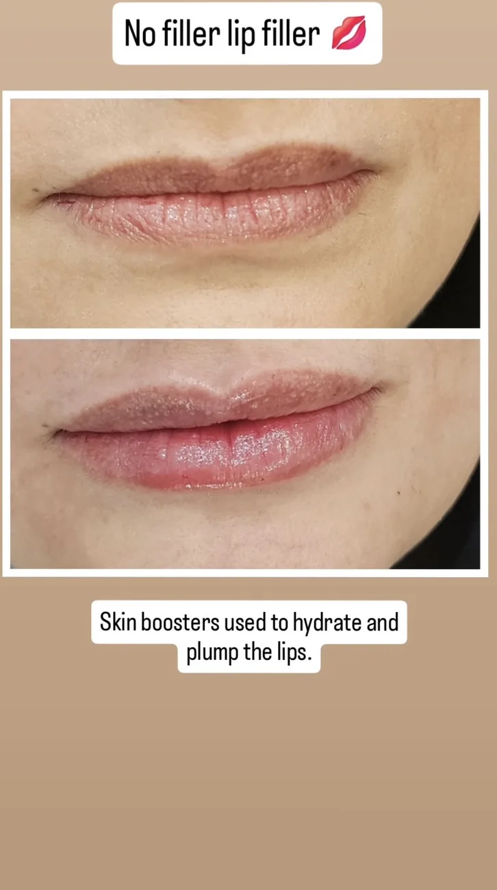 Skin boosters to the lips