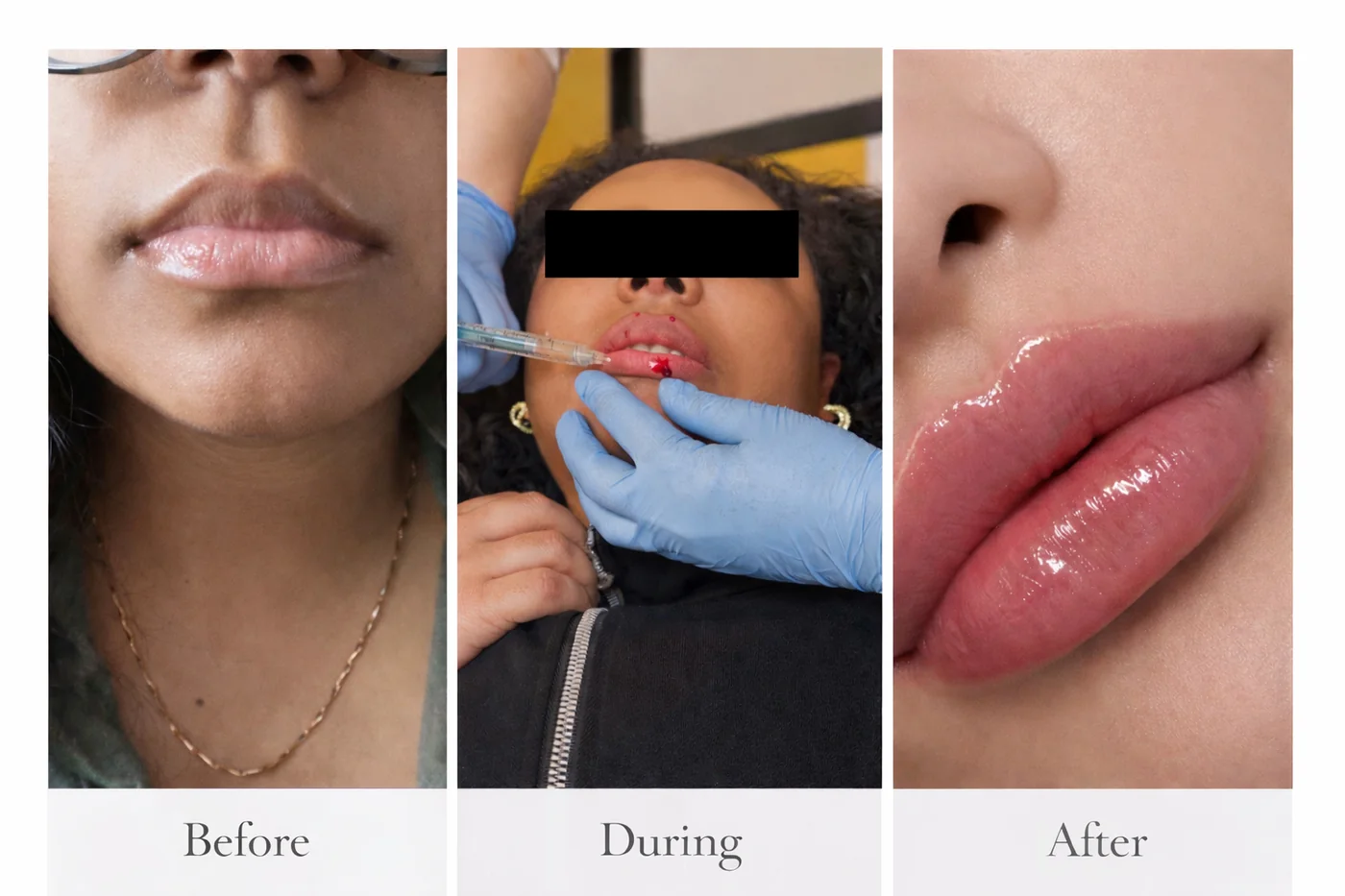 Lip augmentation, stage by stage