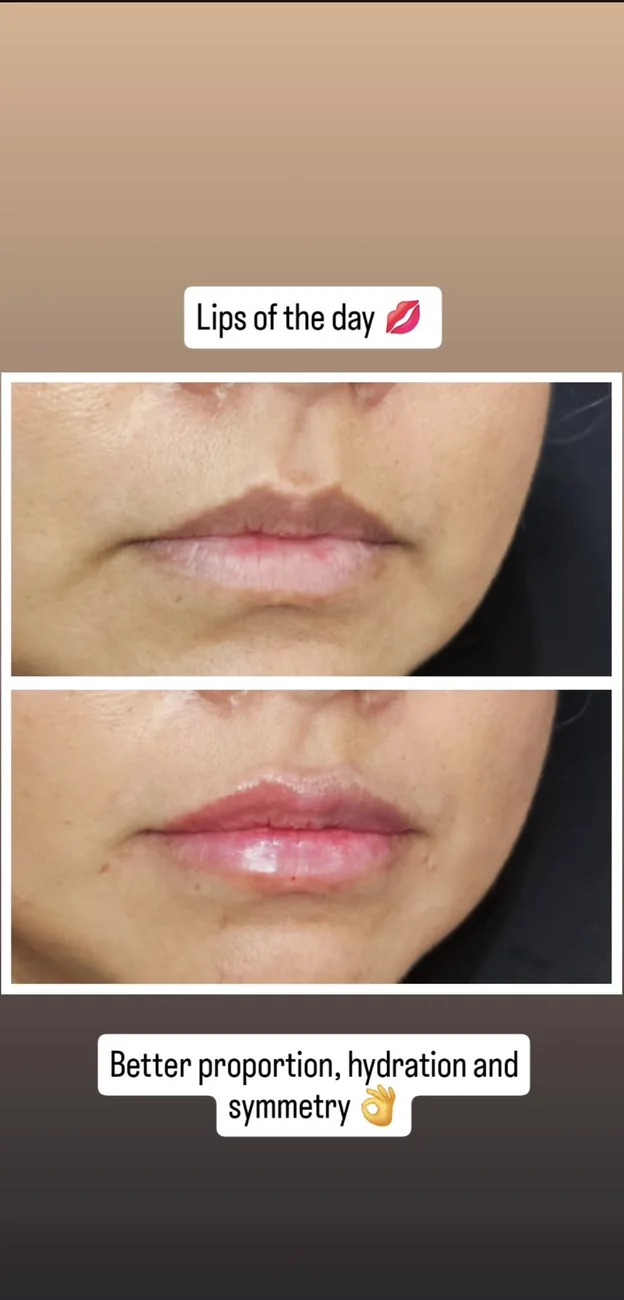 Lip treatment &mdash; proportion & symmetry