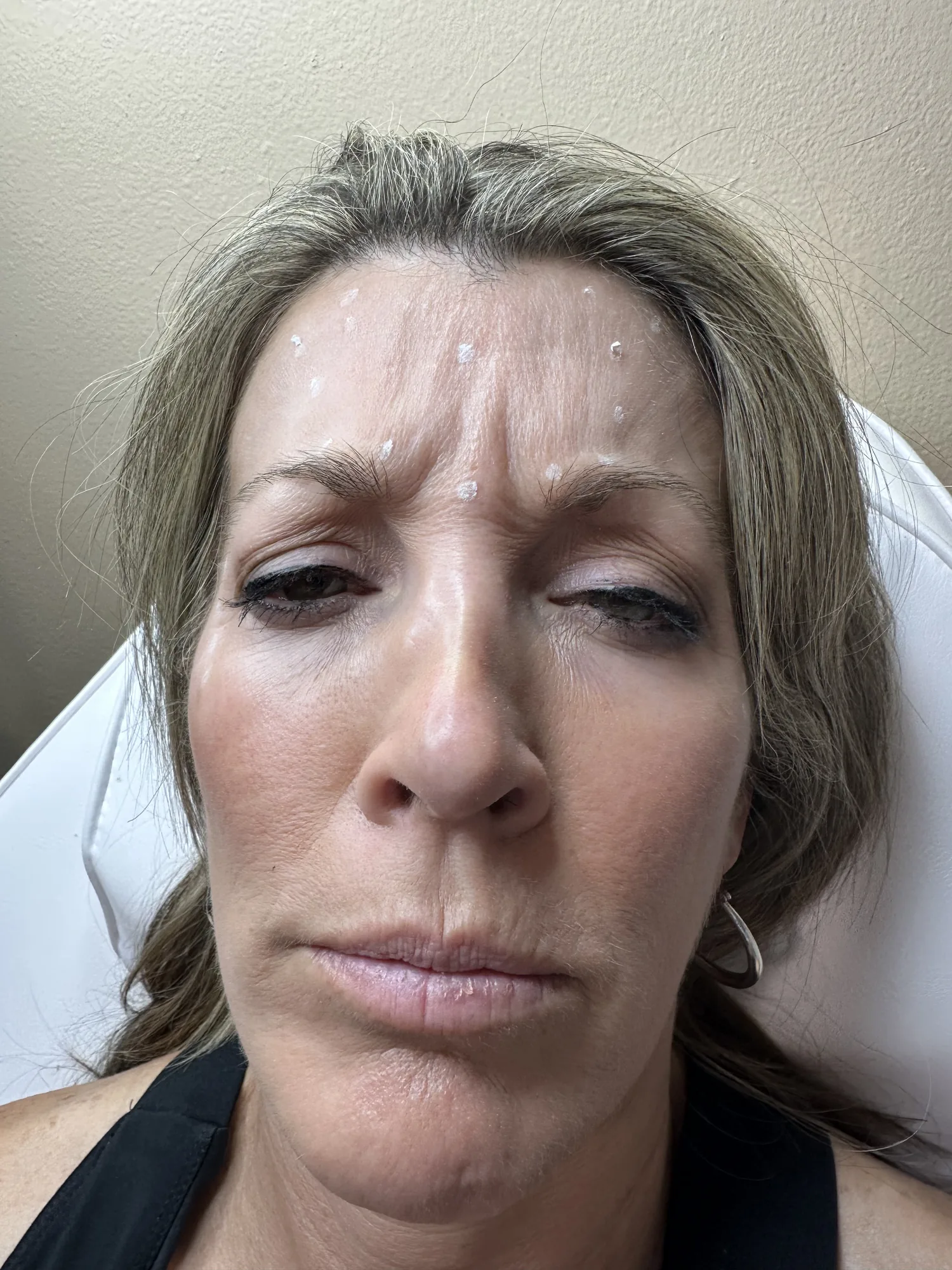 Upper-face treatment &mdash; after