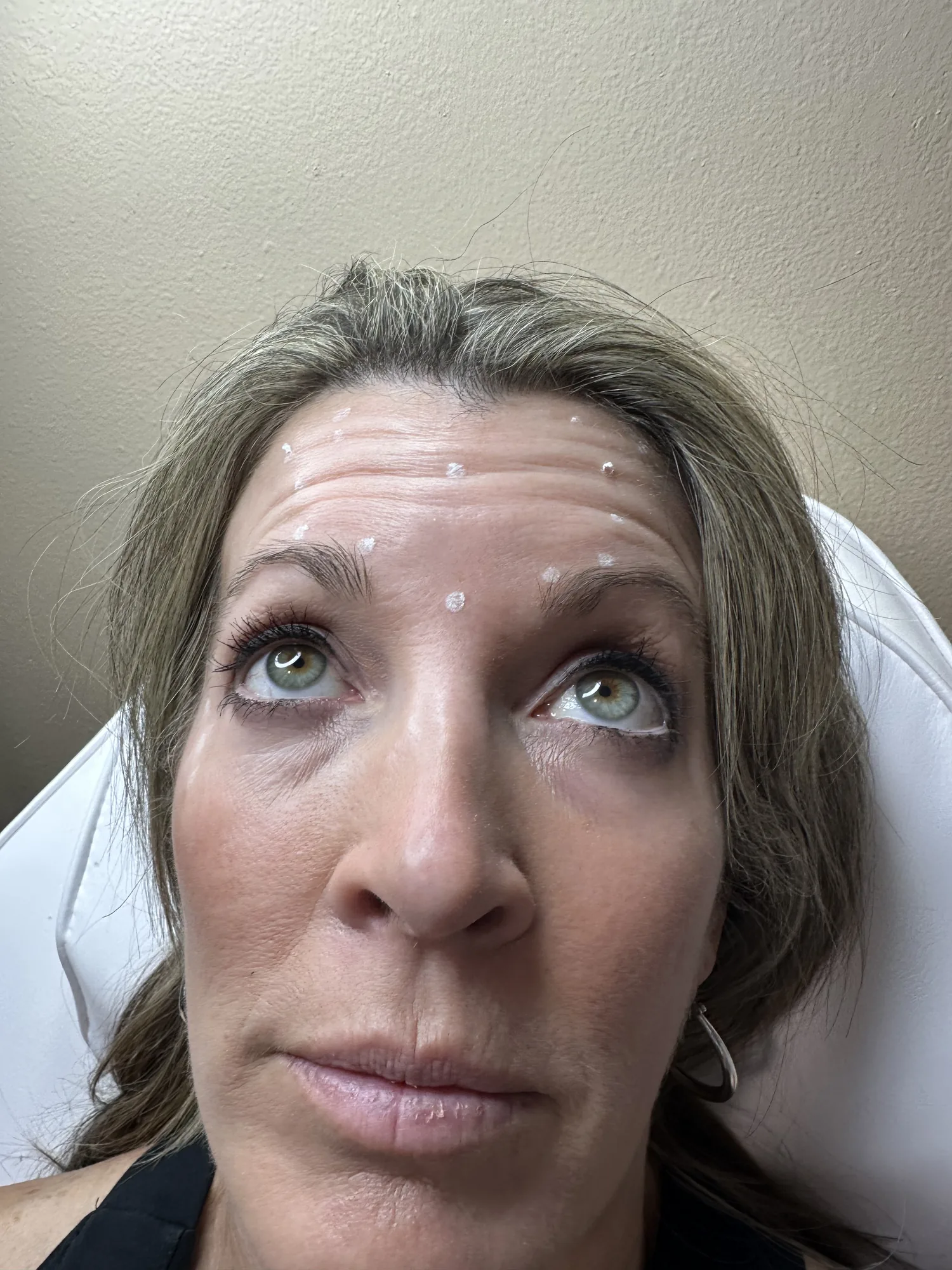 Upper-face treatment