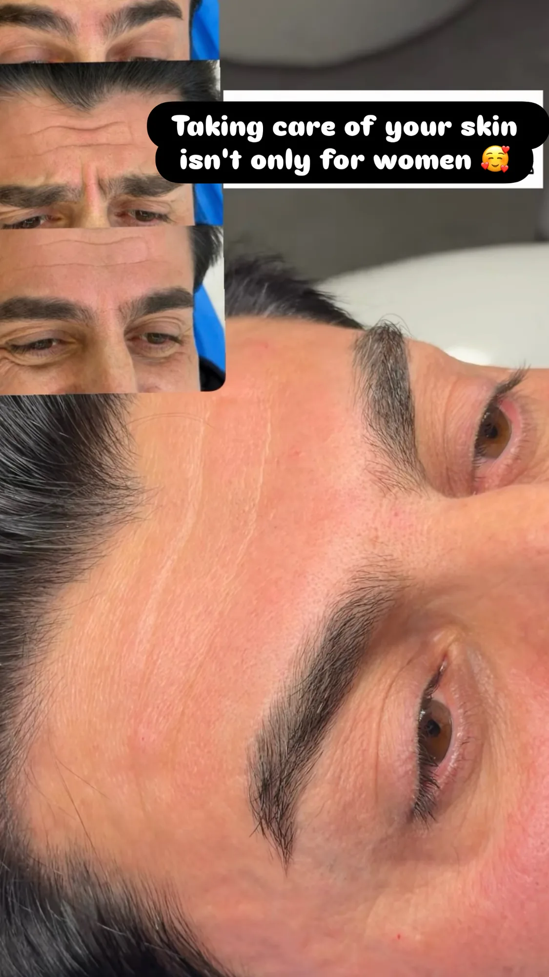 Neuromodulator &mdash; forehead, male patient
