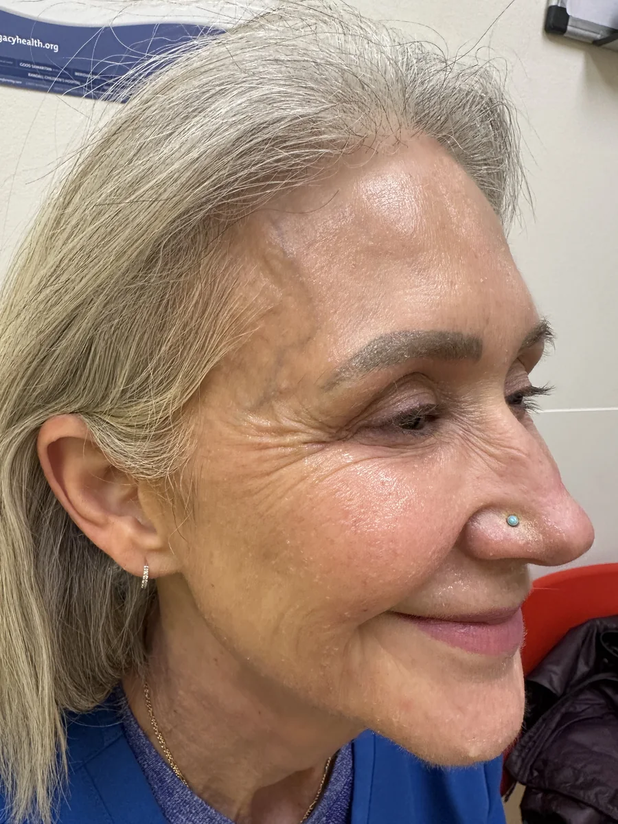 Upper face, profile &mdash; before