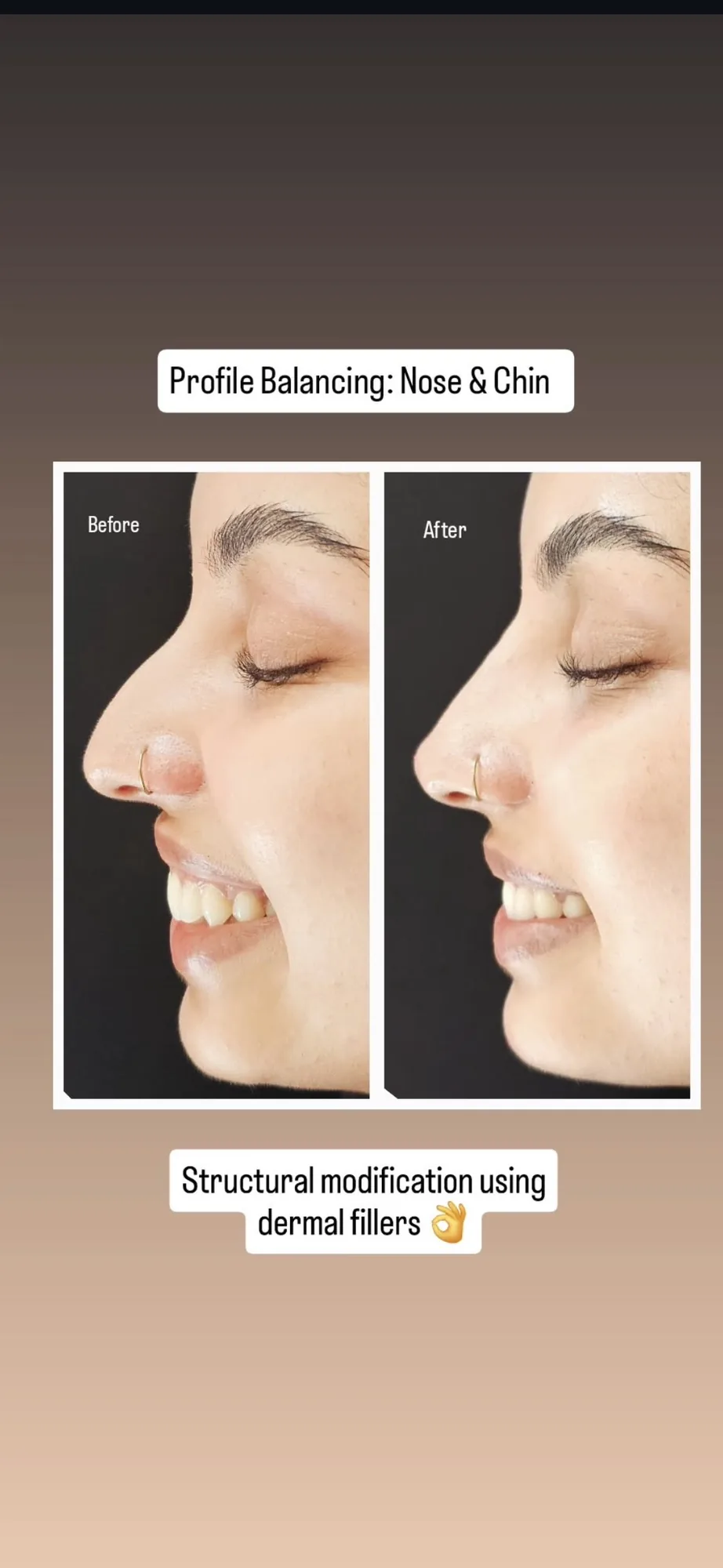 Profile balancing &mdash; nose & chin