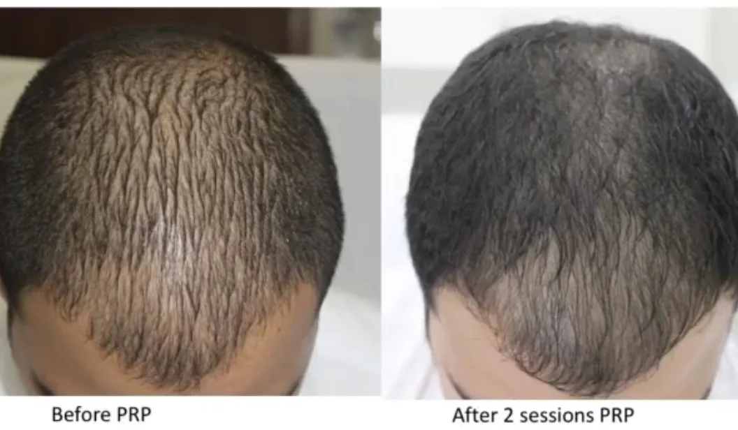 PRP hair restoration
