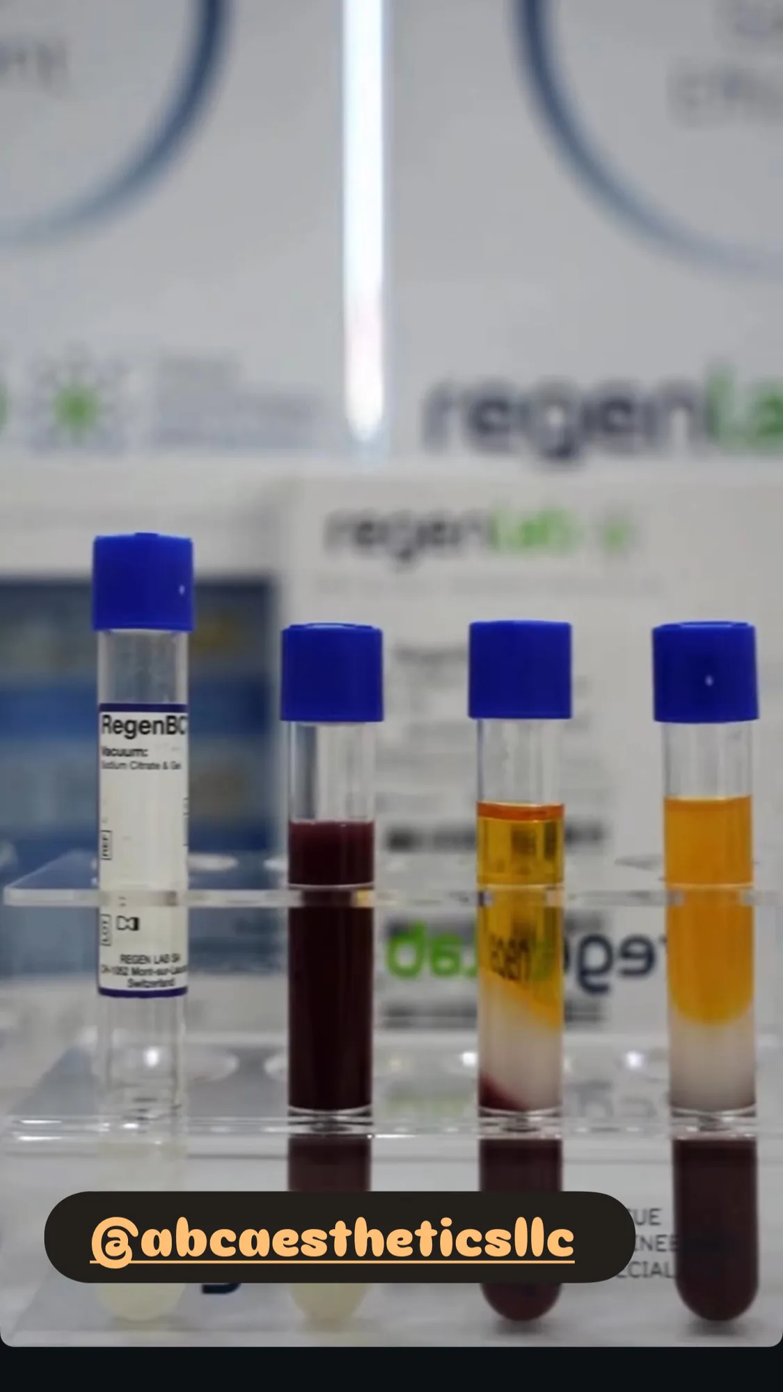 Tubes showing blood separated into platelet-rich plasma after centrifugation