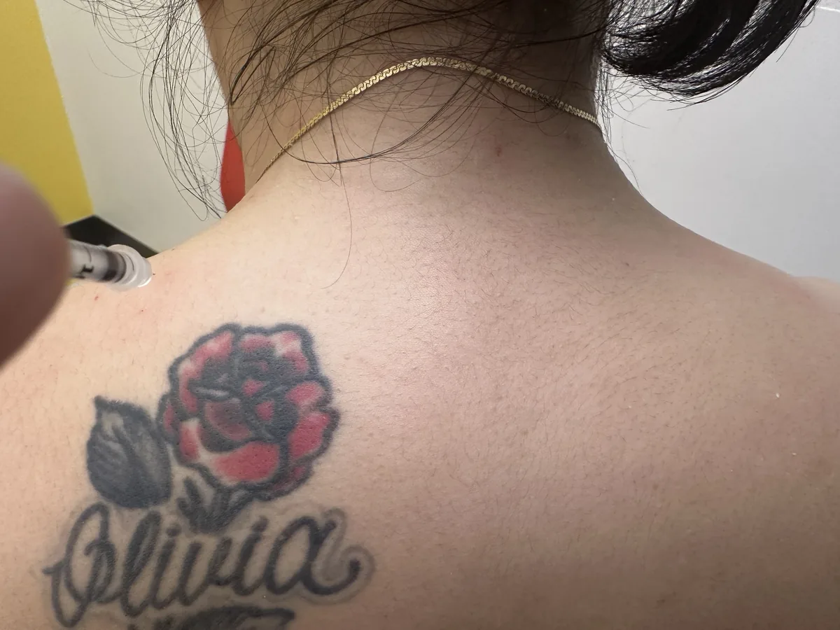 Trapezius treatment (&ldquo;TrapTox&rdquo;)