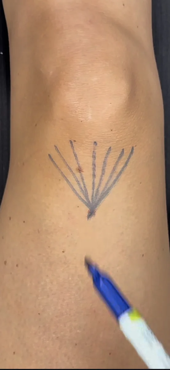 Mapping before treatment