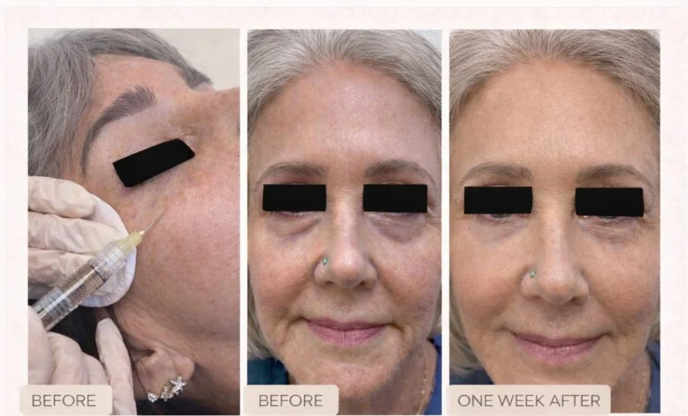 Under-eye rejuvenation
