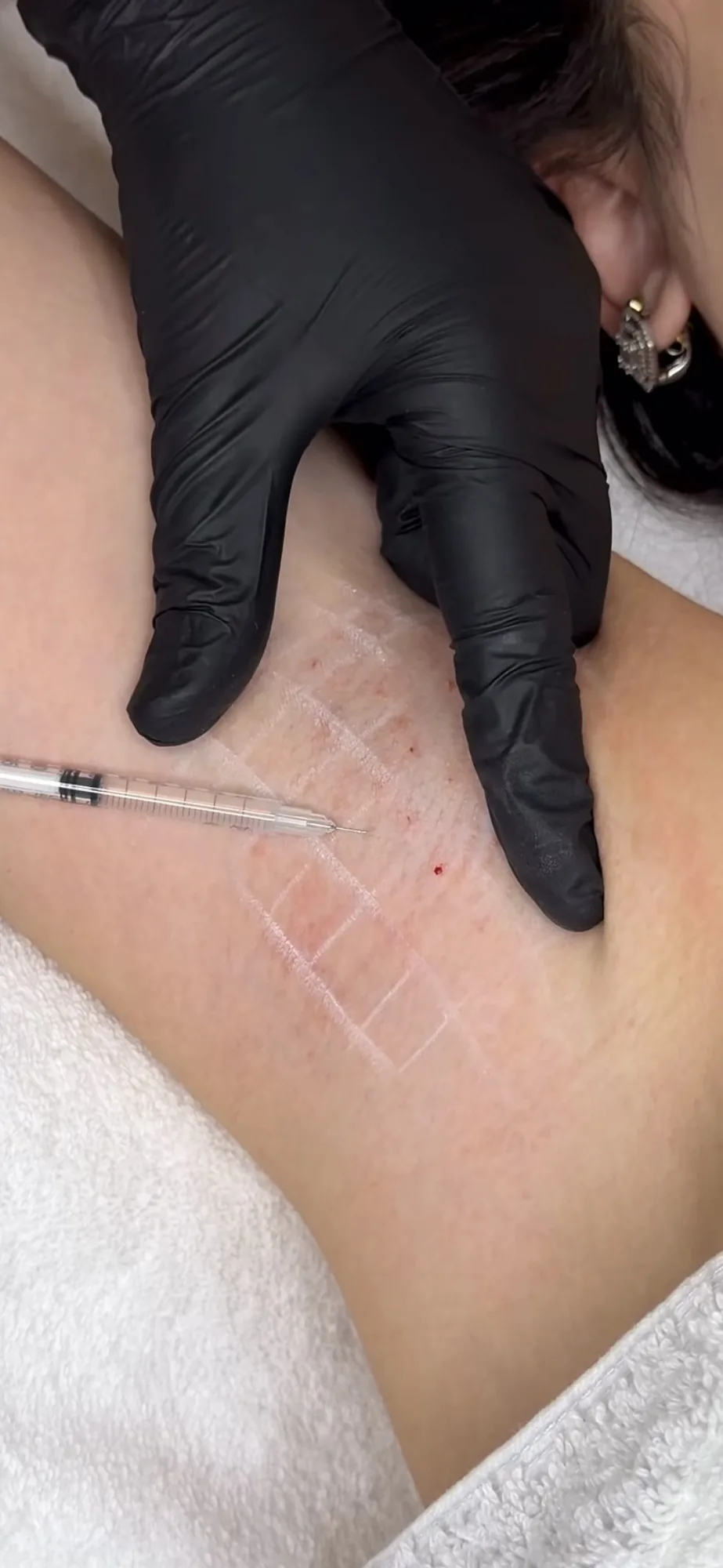 Hyperhidrosis treatment