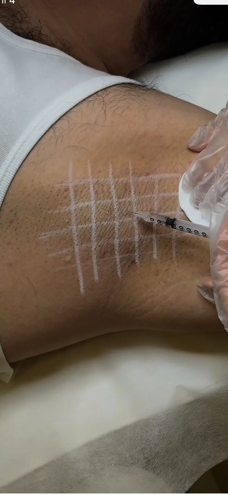 Hyperhidrosis &mdash; treatment mapping