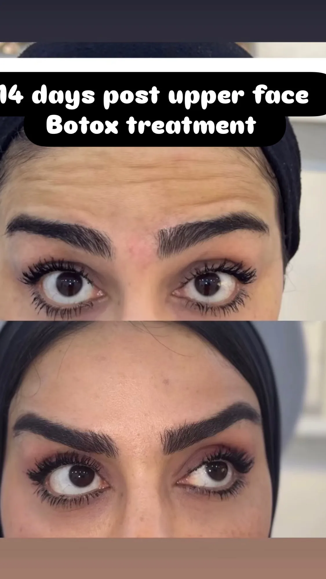 Upper-face treatment &mdash; 14 days